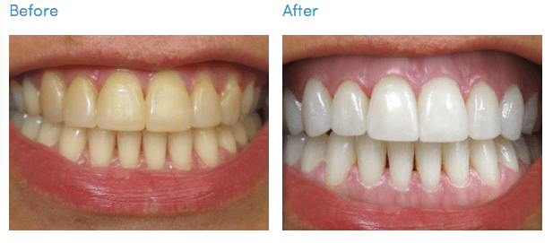 advanced whitening before and after