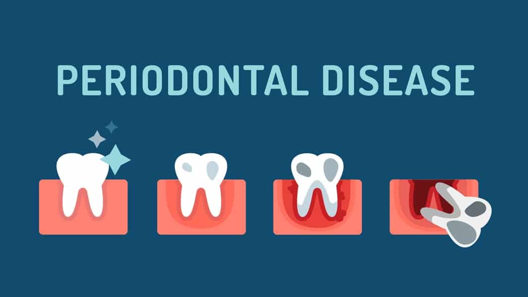 gum disease graphic