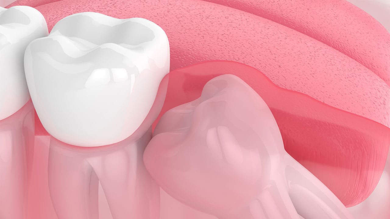 impacted wisdom tooth