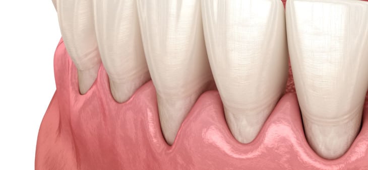 Gum recession graphic