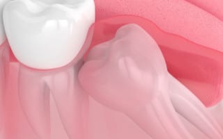 Wisdom tooth impaction