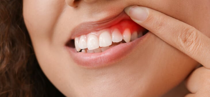 Woman with gum inflammation, closeup