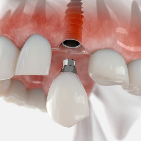 Graphic of a dental implant