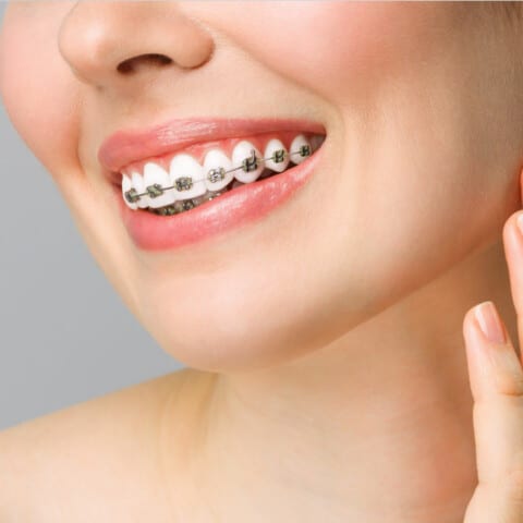Closeup of woman smiling with traditional braces