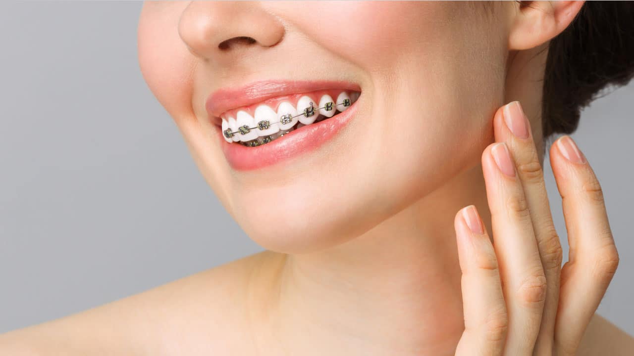 Exploring Alternative Solutions to Traditional Braces - Aurora Dental Group