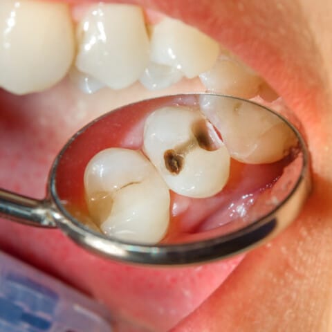 Dentist checking cavity on patient