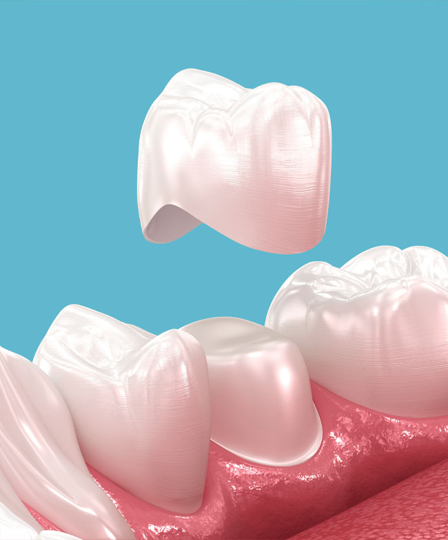 3D rendering of a same-day dental crown restoration