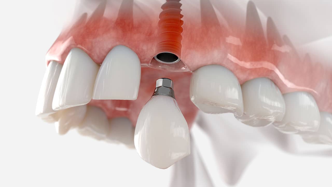 Graphic of a dental implant