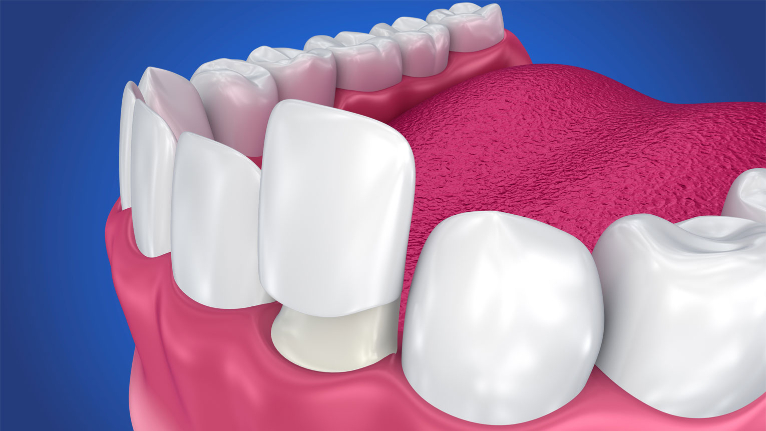 Dental Veneers: Process A Step-by-Step Guide