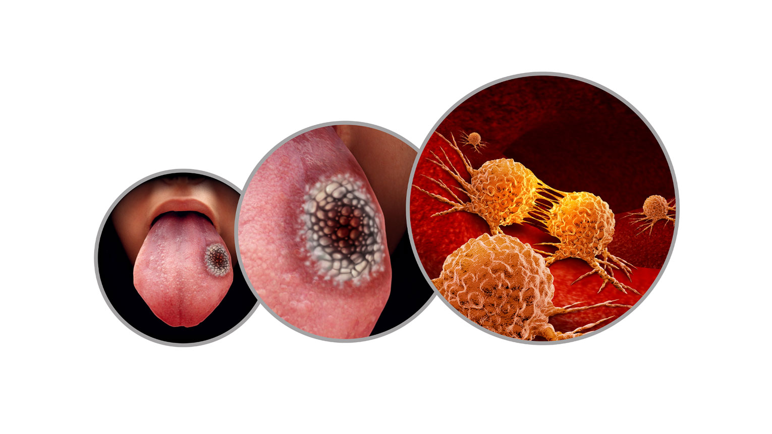 Early Signs of Oral Cancer You Shouldn't Ignore