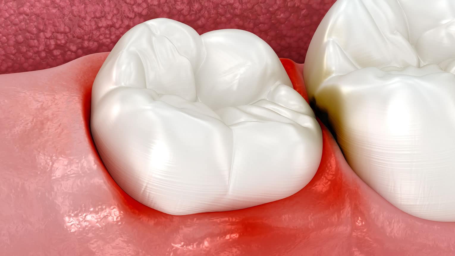 Gum Disease Treatment Options for a Healthier Mouth