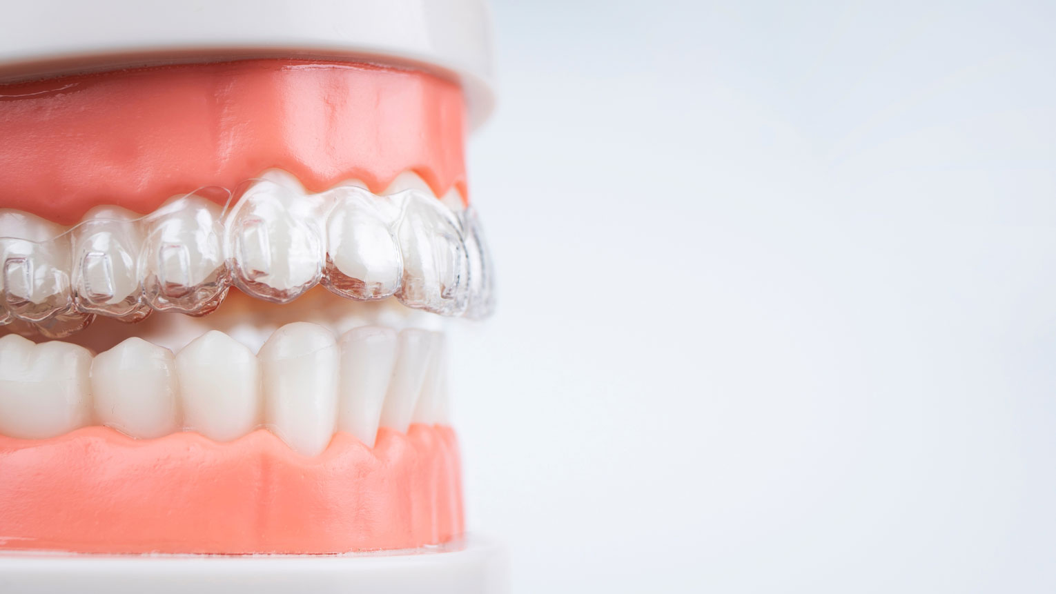 How Long Does Invisalign Take to Work?