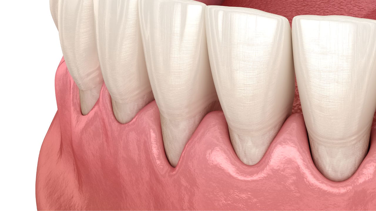 Gum recession graphic