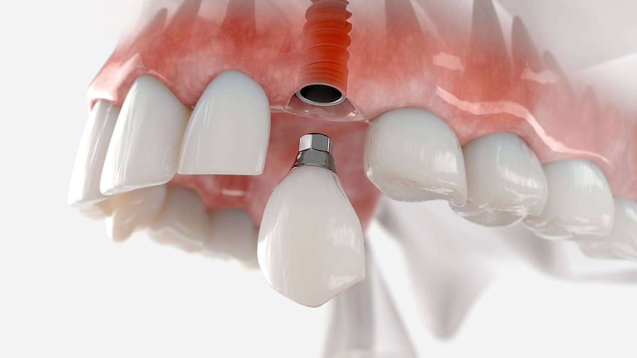 3D rendering of a mouth with a dental implant