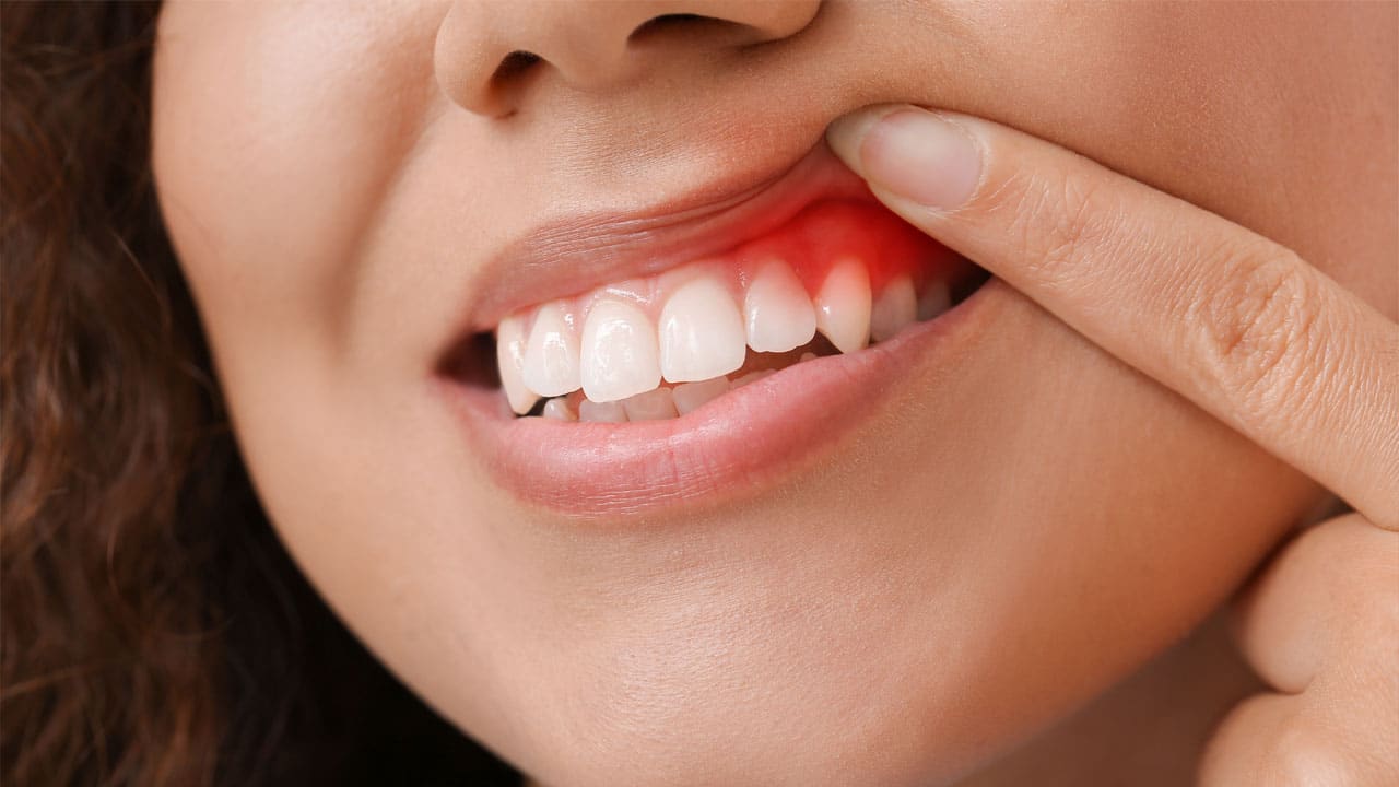 Woman with gum inflammation, closeup